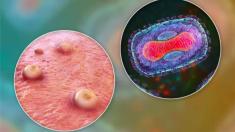 Những điều cần biết về bệnh đậu mùa khỉ khi WHO ‘gióng lên hồi chuông cảnh báo’ (26/08/2024)