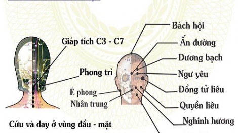 Điều trị những di chứng sau tai biến mạch máu não bằng đông y. (05/4/2016)