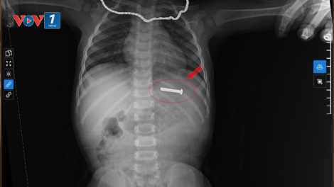 Gắp thành công đinh vít dài 5cm ra khỏi dạ dày bệnh nhi 15 tháng tuổi