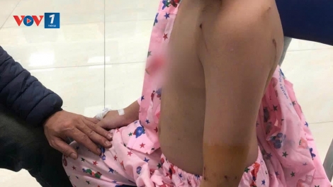 Đi chúc Tết, bé trai 10 tuổi ở Hà Nội bị chó tấn công