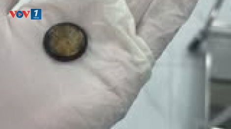 Hà Nội: Bệnh nhi 4 tuổi loét thực quản vì nuốt phải pin cúc áo (11/03/2025)