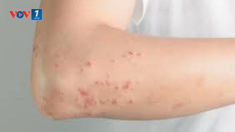 Cảnh giác các biến chứng bệnh sởi ở người lớn
