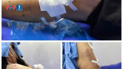 Nhiều trường hợp bị chó tấn công ở Yên Bái (07/05/2025)