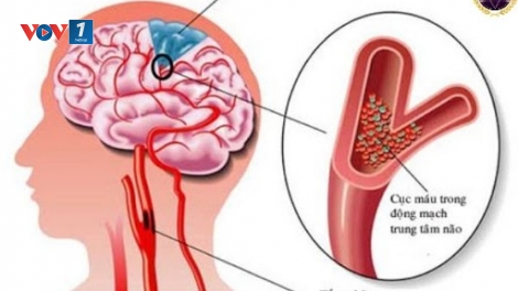 Cứ 3 giây có 1 người bị đột quỵ trên toàn cầu
