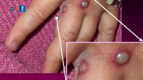 Thái Lan cảnh báo bệnh đậu mùa khỉ.