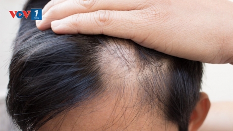 Ngăn ngừa tình trạng rụng tóc ở người trẻ