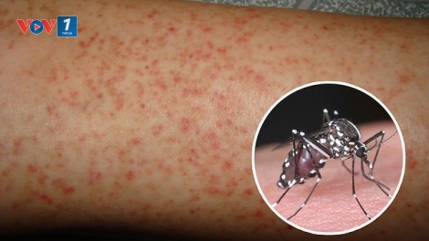 Gia tăng bệnh sốt xuất huyết Dengue nặng tại đồng bằng Sông Cửu Long