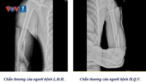 Cảnh báo nguy cơ gãy tay từ trò chơi vật tay
