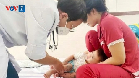 TP HCM: Chủng EV71 nguy hiểm tái xuất, số ca tay chân miệng tăng cao