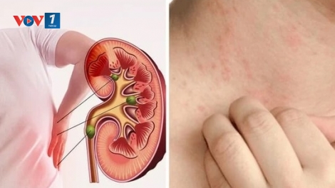 Tình trạng người trẻ tuổi suy thận mạn đang gia tăng nhanh