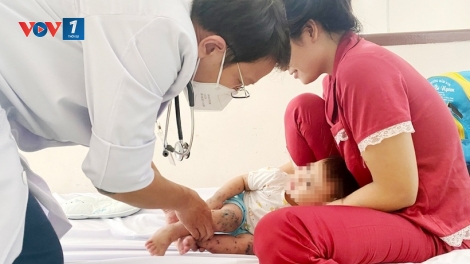 Ca tay chân miệng ở TP.HCM tăng cao