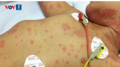 Không để dịch bệnh viêm màng não mô cầu lan rộng tại cộng đồng