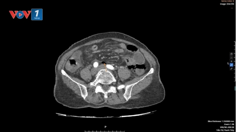 Giành lại sự sống từ ca thủng đại tràng hiếm gặp