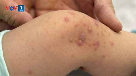 Cảnh báo virus EV71 khiến trẻ mắc tay chân miệng chuyển nặng, gia tăng nguy cơ tử vong