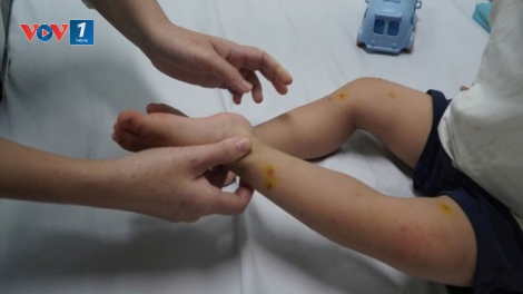 4 ca tử vong do tay chân miệng, Bộ Y tế yêu cầu tăng cường kiểm soát lây nhiễm