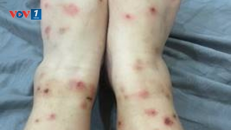 Mùa hè: Phòng ngừa viêm da do bọ chét