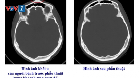 Phẫu thuật thành công ca u xương sọ hiếm gặp từ triệu chứng mơ hồ