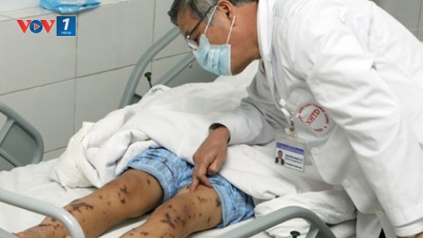 Dịch não mô cầu tiếp tục có diễn biến phức tạp, khi Hà Nội vừa phát hiện ca viêm não mô cầu thứ 2 (Thời sự đêm 4/3/2016)
