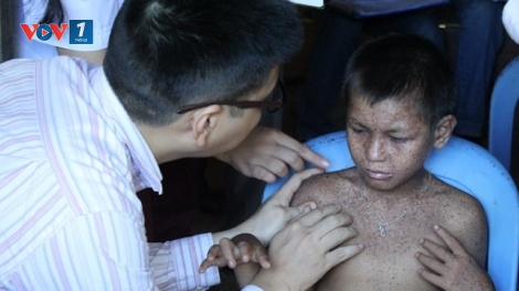 Thời sự đêm ngày 30/6/2015: Cục Y tế dự phòng (Bộ Y tế) nhận định, bệnh lạ ở Phú Thọ là bệnh khô da sắc tố.