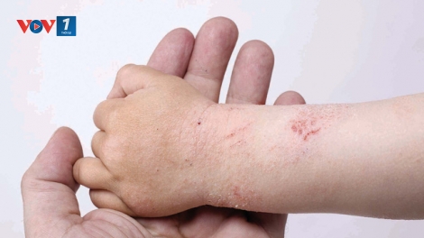 Phòng và điều trị các bệnh về da trong thời tiết giao mùa (3/11/2017)