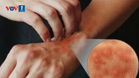 Phương pháp mới trong việc điều trị các bệnh khó chữa về da (11/4/2017)