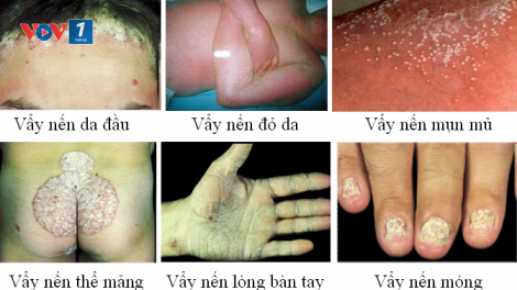 Chế độ ăn uống giúp khống chế và điều trị bệnh vẩy nến (8/8/2017)