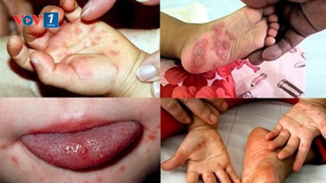 Dịch bệnh tay chân miệng đang tăng nhanh ở các tỉnh từ Bắc trở vào Nam (6/10/2018)