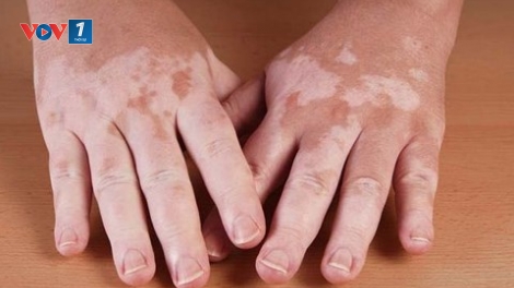 Bát nháo thị trường thuốc chữa bệnh bạch biến (20/12/2018)