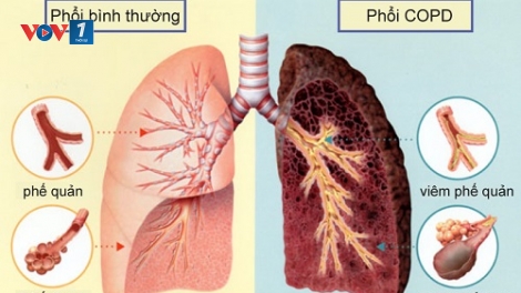 Bệnh phổi tắc nghẽn mạn tính và những điều cần biết (23/12/2018)