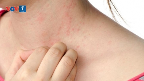 Nguy cơ mắc các bệnh thường gặp về da trong thời điểm giao mùa (27/9/2018)