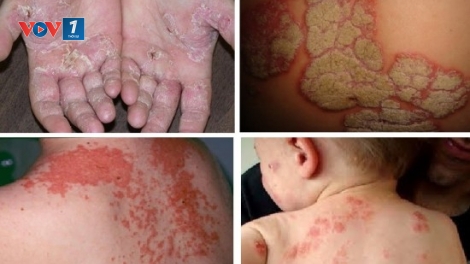 Điều trị bệnh vẩy nến và viêm da cơ địa thế nào cho hiệu quả (19/1/2019)