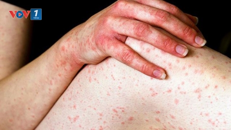 Tư vấn điều trị các bệnh về da khi thời tiết giao mùa (11/5/2019)