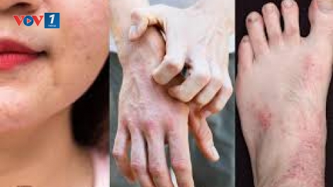 Bệnh viêm da dị ứng vào mùa hè: Nguyên nhân và hướng điều trị (22/6/2019)