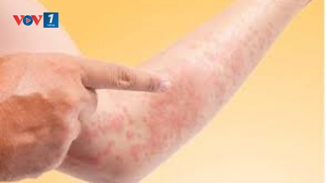 Tìm hiểu về bệnh mề đay mùa nắng nóng (20/7/2019)