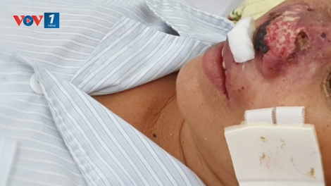 Vi khuẩn "ăn thịt người'" - hoang mang và phòng ngừa, điều trị căn bệnh này như thế nào? (16/9/2019)