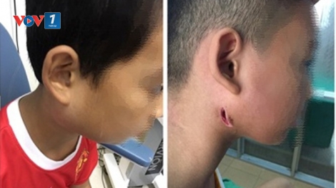 Bệnh do vi khuẩn Whitmore: Kiểm soát bệnh từ ý thức của mỗi người (21/9/2019)