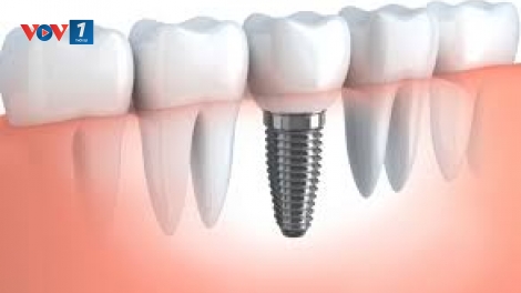 Công nghệ cấy ghép Implant trong nha khoa (14/1/2020)