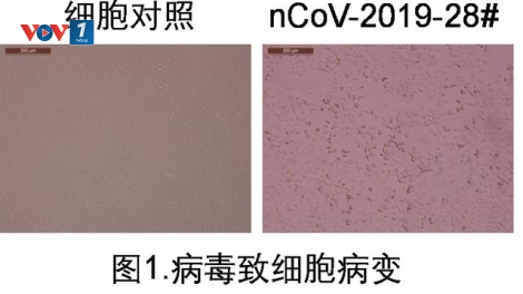 Trung Quốc phân lập được Covid 19 trong nước tiểu người bệnh (22/2/2020)