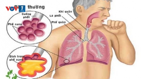 Tìm hiểu về bệnh viêm phế quản và thủ phạm thuốc lá (1/3/2020)