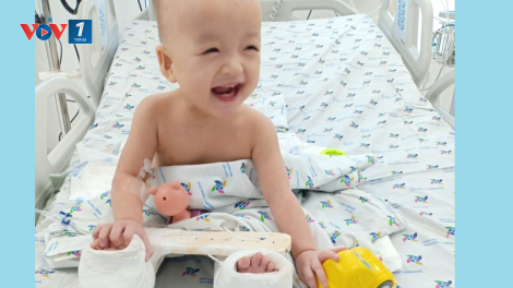 1 tháng sau mổ tách dính, chân Song Nhi đã khép được 1 nửa khung bột (15/8/2020)