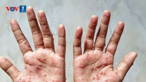 Diễn biến bệnh đậu mùa khỉ và các giải pháp phòng ngừa (22/10/2023)
