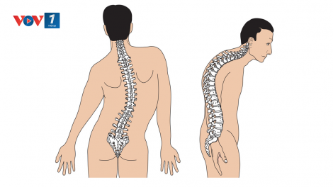 Tư vấn các bệnh gù vẹo cột sống (27/5/2023)