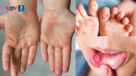 THỜI SỰ 21H30 ĐÊM 31/7/2023: Cục Quản lý dược, Bộ Y tế cho biết đã có nguồn cung thuốc điều trị bệnh tay chân miệng