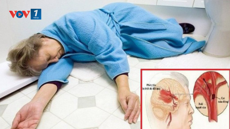 Khi bị bệnh đột quỵ cần chú ý gì? (23/3/2024)