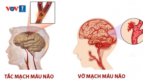 Phòng ngừa, điều trị bệnh đột quỵ ngày càng trẻ hóa (27/7/2024)