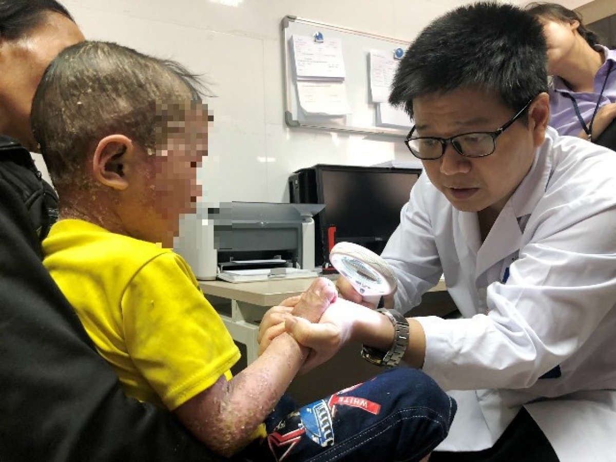 PGS.TS.BS Lê Hữu Doanh khám bệnh cho 1 bệnh nhân bị biến chứng vảy nến nặng