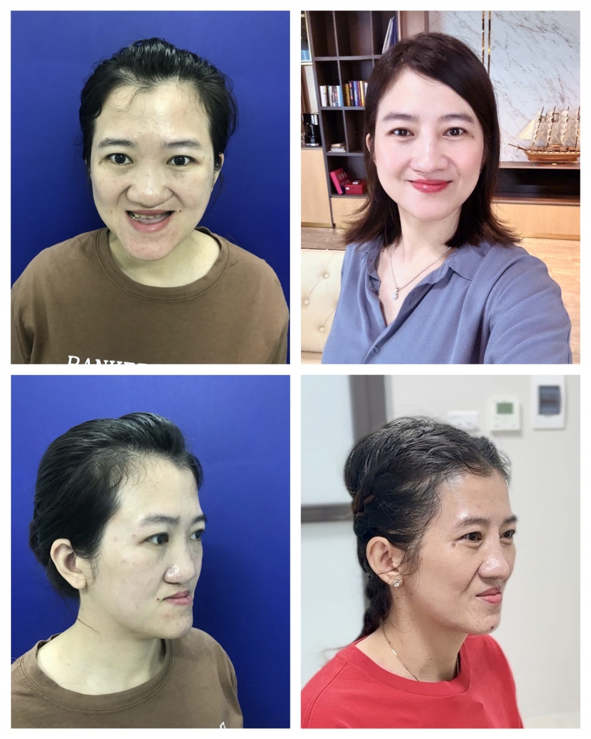 Nụ cười trọn vẹn đã đến với chị G sau ca phẫu thuật tại BV Hữu nghị Việt Đức