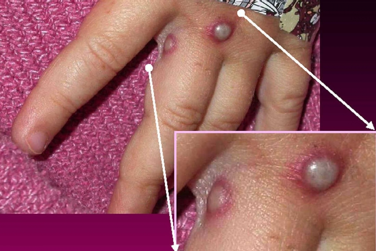 Ảnh bệnh đậu mùa khỉ - Nguồn Bệnh viện bệnh nhiệt đới Việt Nam