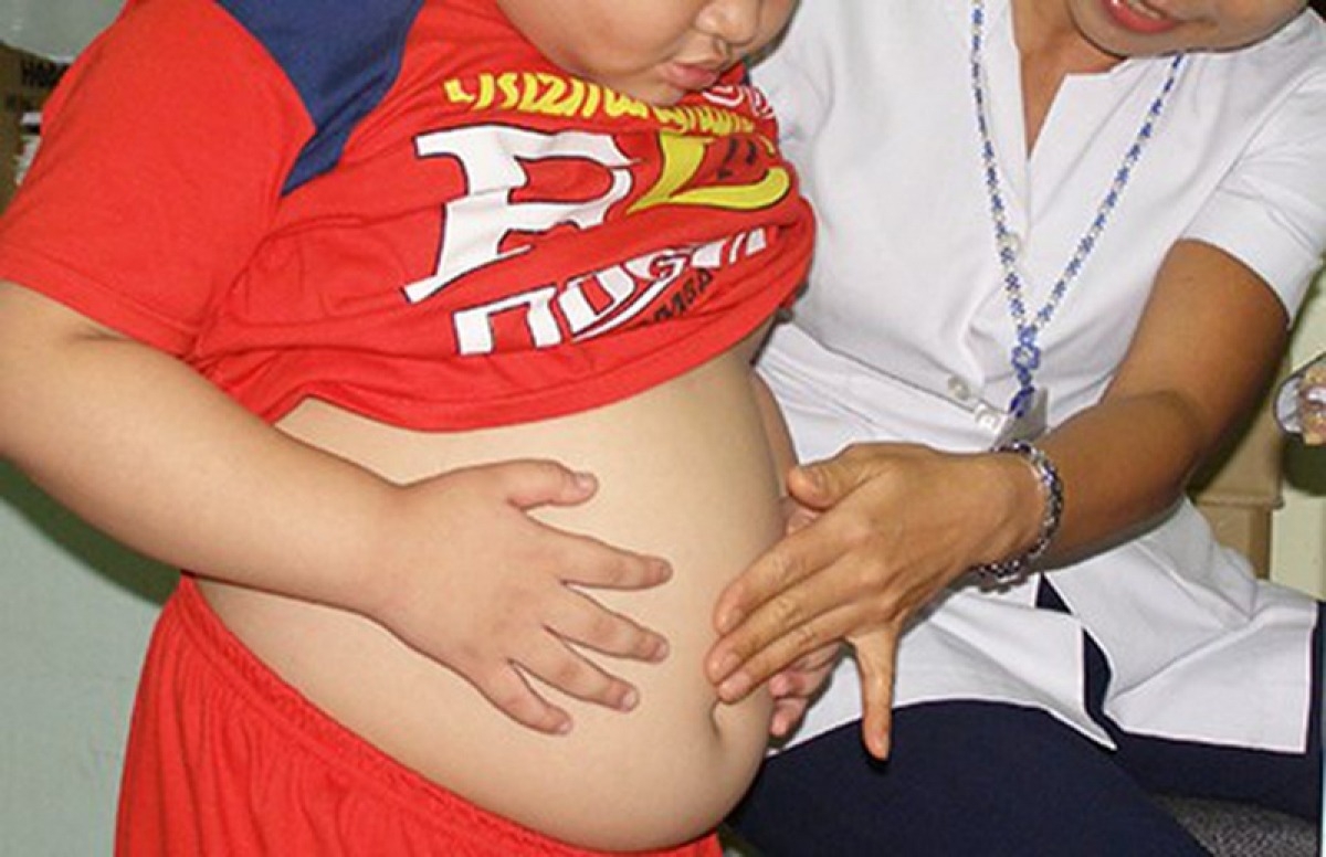 Theo WHO, béo phì ở trẻ em là một trong những gánh nặng sức khỏe cộng đồng nghiêm trọng nhất của thế kỷ 21.
