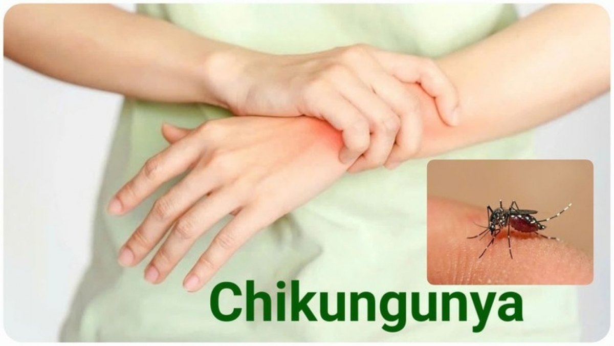Bệnh Chikungunya đang diễn biến phức tạp, chuyên gia khuyến cáo người dân không hoang mang nhưng cũng không chủ quan